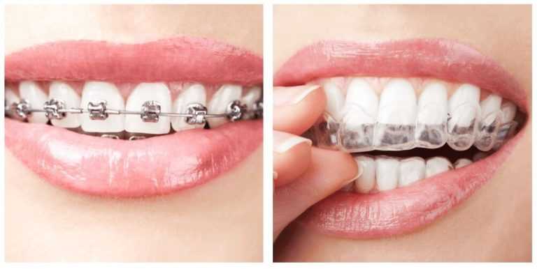 Braces & Aligners